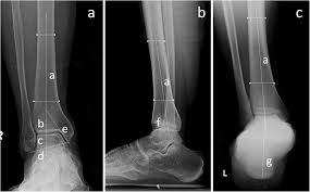 Image result for Talar Tilt