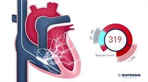 Comparison of an implantable cardioverter defibrillator and a pacemaker. Implantable Cardioverter Defibrillator Icd Therapy Youtube