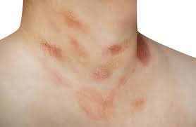 Image result for psoriasis