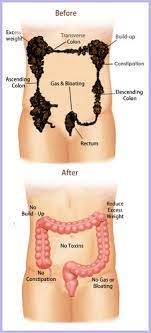 See full list on bodynutrition.org Colon Cleansing Hydrotherapy In Hyderabad Id 7474118688