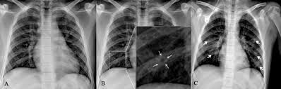 Doctors use them to diagnose problems. Pediatric Chest X Ray In Covid 19 Infection European Journal Of Radiology