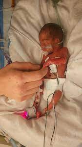 My twins were born early at 32 weeks, my daughter caitlin was born with a diaphragmatic hernia with 65% of her diaghphram missing. As you could imaging she was a very sick