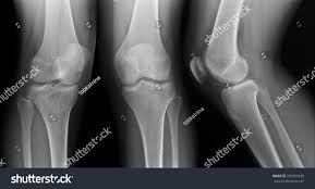 Image result for Knee XRay