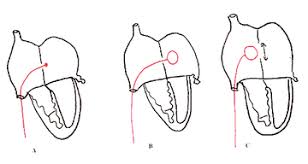 Transposition des gros vaisseaux , locution. Transpositions Des Gros Vaisseaux Imagerie Des Malformations Cardiaques