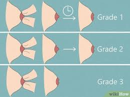 Image result for Nipple Inversion