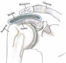 Acromion types as classified according to bigliani is a faster way to differentiate. Impingement Syndrome Corporate