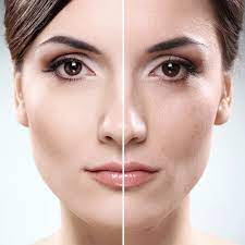 Fractional CO2 at the womens Health Centre - fractionallaser.co.nz