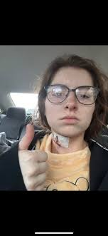 Neck Transplant Surgery and Recovery Experience