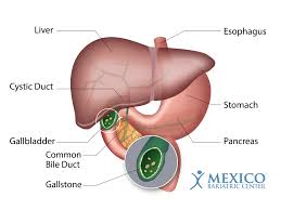 gallstones after weight loss surgery