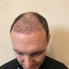 The below hair transplant patient volunteered to document his progress from start to finish over 18 months. Stages Of Hair Transplant Growth See This Patient S Hair Grow After A Transplant