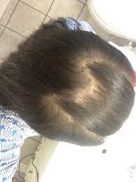 These best hairstyles for balding men make the most of the stages of hair loss. My Hair Is Thinning With Very Shiny Scalp And Vellus Hair All Over My Scalp That Seems To Be Almost Colorless Photos