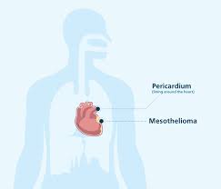 Maybe you would like to learn more about one of these? The 4 Types Of Mesothelioma Pleural Peritoneal Cell Types