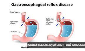 Gerðr is sometimes modernly anglicized as gerd or gerth. Ø§Ø±ØªØ¬Ø§Ø¹ Ø§Ù„Ù…Ø±ÙŠØ¡ Gerd Ø£Ø³Ø¨Ø§Ø¨Ù‡ ÙˆØ£Ø¹Ø±Ø§Ø¶Ù‡ ÙˆÙ…Ø¶Ø§Ø¹ÙØ§ØªÙ‡ ÙˆÙƒÙŠÙÙŠØ© Ø§Ù„ÙˆÙ‚Ø§ÙŠØ© Ù…Ù†Ù‡