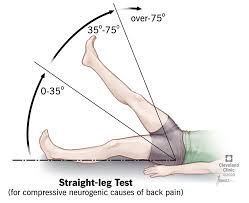 Sciatica treatment video sciatica treatments will vary depending on whether the pain is in its early stages or if it is chronic. Sciatica Causes Symptoms Treatment Prevention Pain Relief