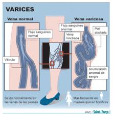 Varices La Deformacion De La Vena Hinchada Salud Ediciones