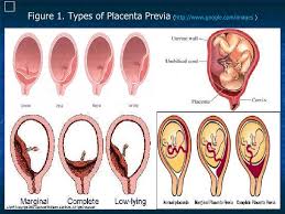 We did not find results for: Third Trimester Bleeding