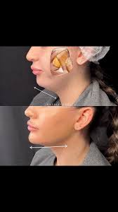 Facial Profiling: The Secret to Full Face Remodelling 🩷💉, Balancing  facial proportions isn’t just about one area—it’s about harmonizing the  entire face. With precise filler placement, we restore ...