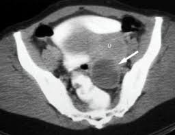 Wide of the fallopian tube, resulting in menstrual blood without obstruction. Endometriosis Brisbane Centre For Endometriosis