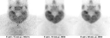 Image result for Multinodular Goiter