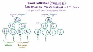 Down Syndrome Trisomy 21 Pediatrics Msd Manual Professional Edition