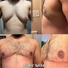 Image result for Gynecomastia