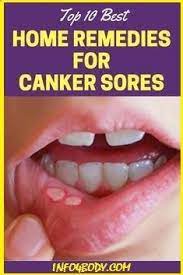 Ulcers Prevention And Natural Remedies There Are Different Types Of Ulcers The Gastric Or Peptic Affecting The L Canker Sore Canker Sore Remedy Mouth Sores