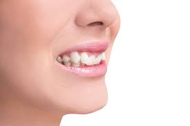 You can correct your overbite at any point. Your Overbite Guide Causes And Treatment Methods Absolute Dental