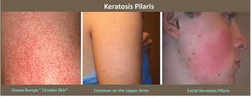 Image result for Keratosis pilaris