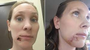 Skin cancer is an uncontrolled growth of skin cells and most often develops on skin exposed to ultraviolet (uv) radiation. This Woman S Blackhead Turned Out To Be Skin Cancer Allure