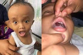 Bantu Fabian Wujudkan Operasi Sumbing Langit-Langit dan Hidrosefalus