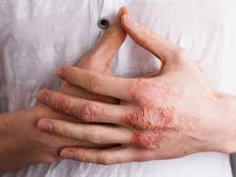 Most Effective Ways To Use Coconut Oil For Eczema Organic Facts