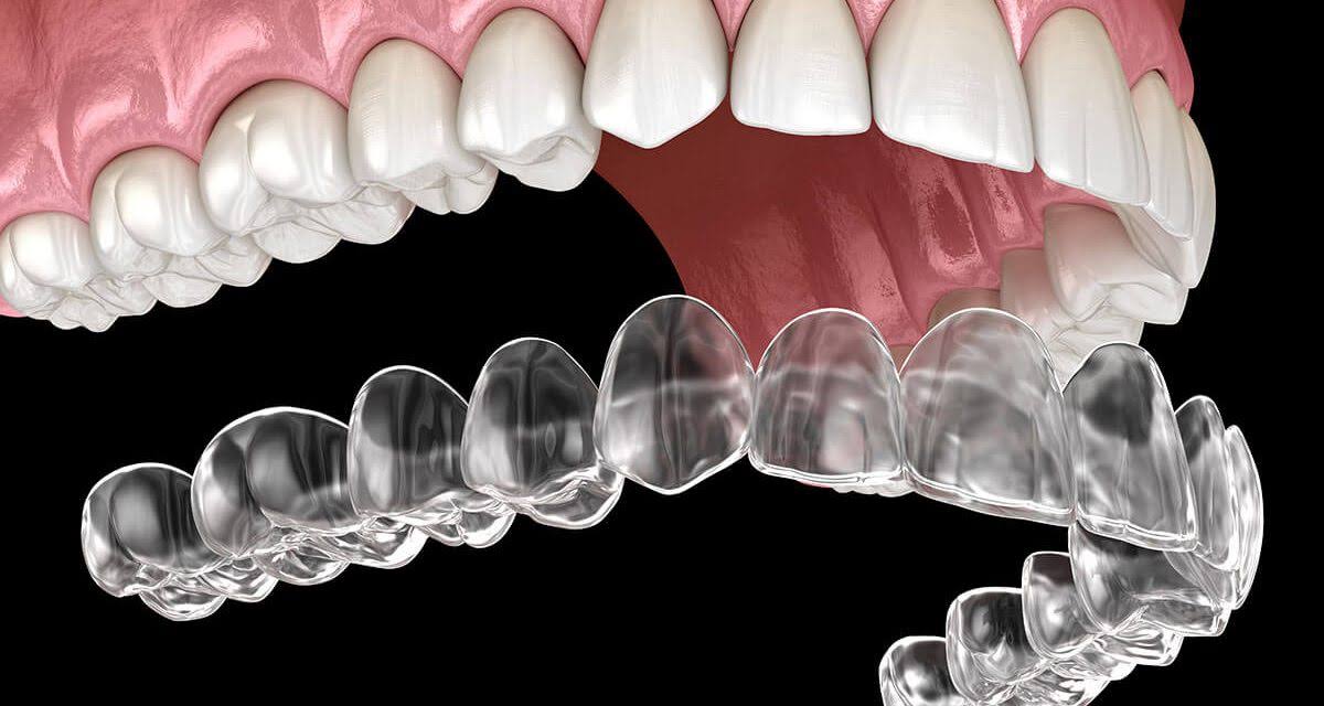 Illusion Aligners product image