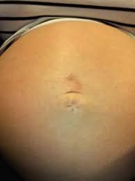 Belly Piercing Hole Skin Hurts August 2015 Babycenter Australia