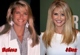 Christie Brinkley Before And After Facelift Surgery Face Lift Surgery Christie Brinkley Plastic Surgery Mini Face Lift