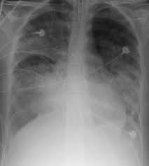 L'œdème pulmonaire, parfois appelé œdème aigu du poumon (oap), se caractérise par une accumulation de liquide dans les alvéoles. Syndrome De Detresse Respiratoire Aigue Wikipedia