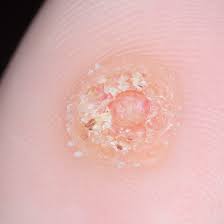 How to get rid of plantar warts on feet naturally: Can You Recognize Plantar Warts On Feet