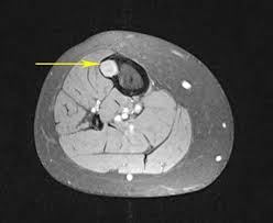 It also helps doctors predict how well you will recover.find the right place for a biopsy.plan X Rays Ct Scans And Mris Orthoinfo Aaos