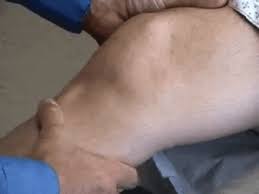 Image result for Lachman Test