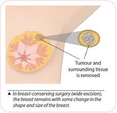Check spelling or type a new query. Breast Cancer Treatment Breast Cancer Surgery K W Ong Breast General Surgery K W Ong Medical Consultancy Breast General Surgery