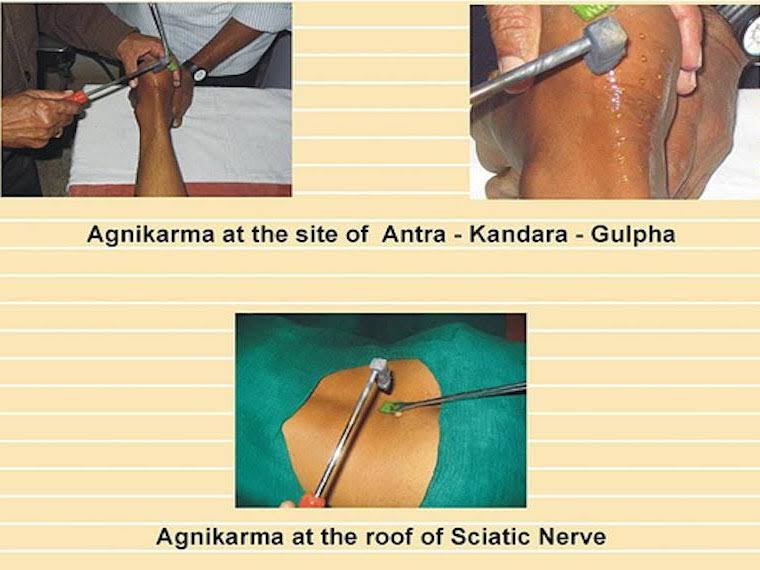 pain management agnikarma 20 % off product image
