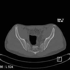 This is a key surface landmark , and easily palpated. Avulsion Fractures Of The Pelvis In Adolescents Eurorad