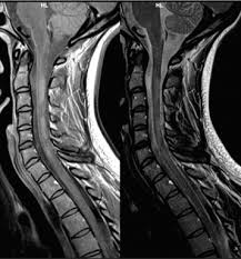 La esclerosis múltiple (em) o esclerosis de placas es una enfermedad neurológica crónica de naturaleza inflamatoria y autoinmune caracterizada por el desarrollo de lesiones desmielinizantes, y de daño axonal en el sistema nervioso central. Recomendaciones Para La Utilizacion E Interpretacion De Los Estudios De Resonancia Magnetica En La Esclerosis Multiple Sciencedirect