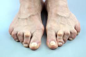 Do you have a bump, lump or bone spur on top of your foot? Pain At Big Toe Joint Causes And Relief