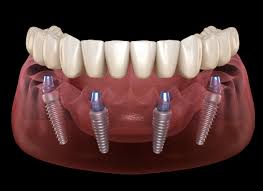 We did not find results for: How Long Do All On 4 Implants Last Here S What You Need To Know