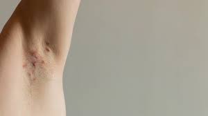 Akne inversa: Ursachen, Symptome, Therapie | gesund.bund.de