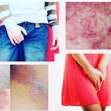 Kesan sisik pada kulit pun dah hilang tanpa kesan. Ubat Gatal Kemaluan Ozpure Atasi Pedih Gatal Eczema Facebook