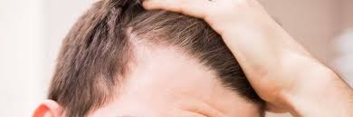 Un ragazzo su 5 (il 18% del campione di analisi) di età compresa tra i 12 e i 20 anni soffre di calvizie giovanile e quindi perdita dei capelli . Stempiatura Nell Uomo E Diradamento Dei Capelli Nella Donna