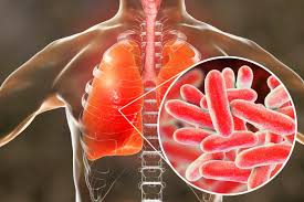 Legionnaires' disease is a severe, often lethal, form of pneumonia. Legionella Testing And Inspection Mse Environmental
