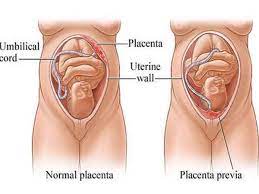 We did not find results for: Plasenta Previa Gejala Penyebab Obat Dan Perawatannya Good Doctor Tips Kesehatan Chat Dokter Beli Obat Online