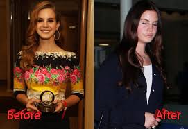 This video on her plastic . Lana Del Rey Plastic Surgery Before And After3 Plastic Surgery Mistakes
